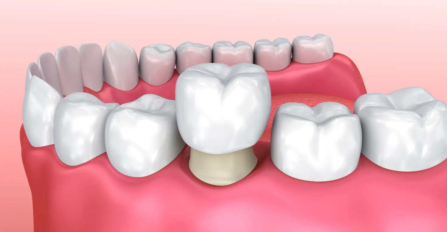 Best Crown for Molars 2